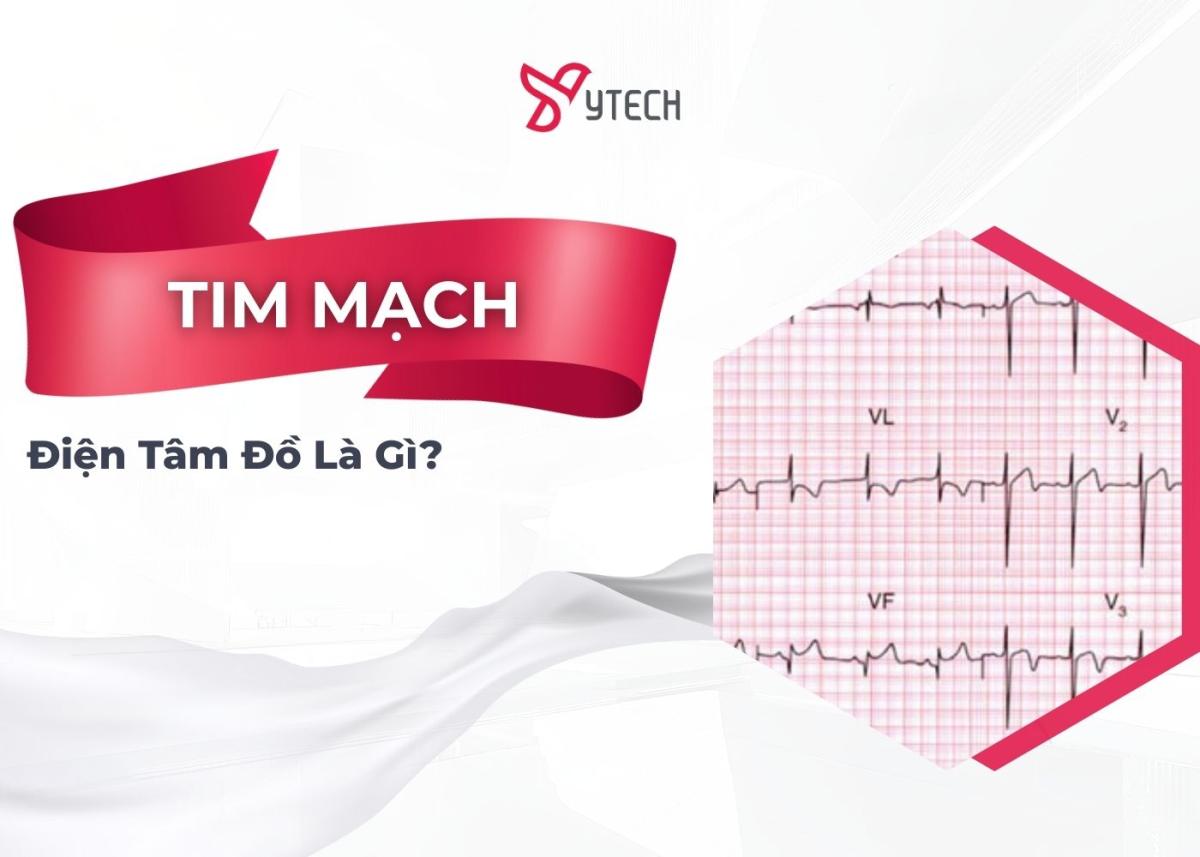 Điện tâm đồ là gì?