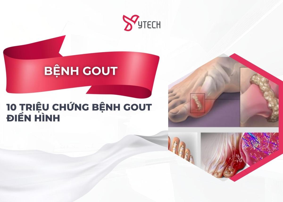 10 TRIỆU CHỨNG BỆNH GOUT ĐIỂN HÌNH HƯỚNG DẪN NHẬN BIẾT SỚM CƠN GOUT CẤP