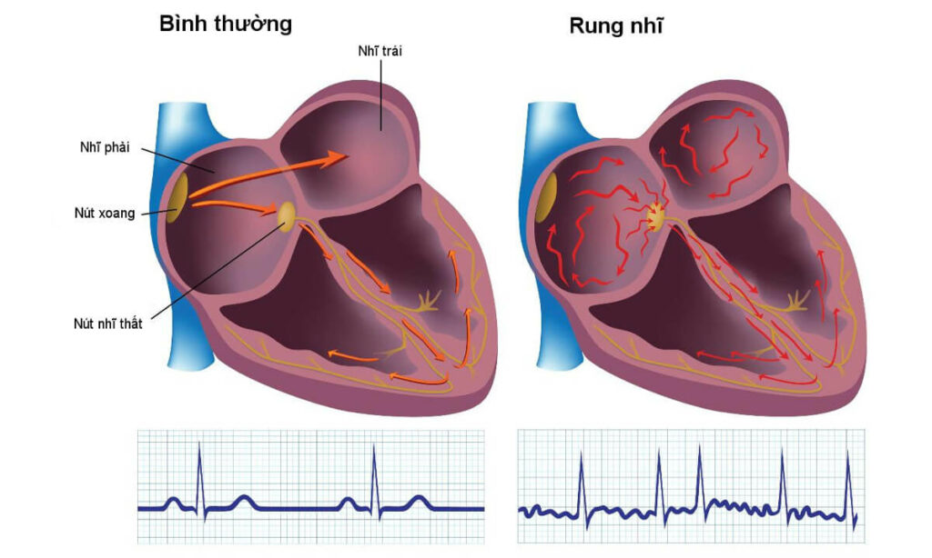Hình ảnh điện tâm đồ (ECG) là chìa khóa giúp bác sĩ và chính bạn nhận diện sự khác biệt rõ rệt giữa một trái tim khỏe mạnh và một trái tim đang mắc hội chứng rung nhĩ (AFib).