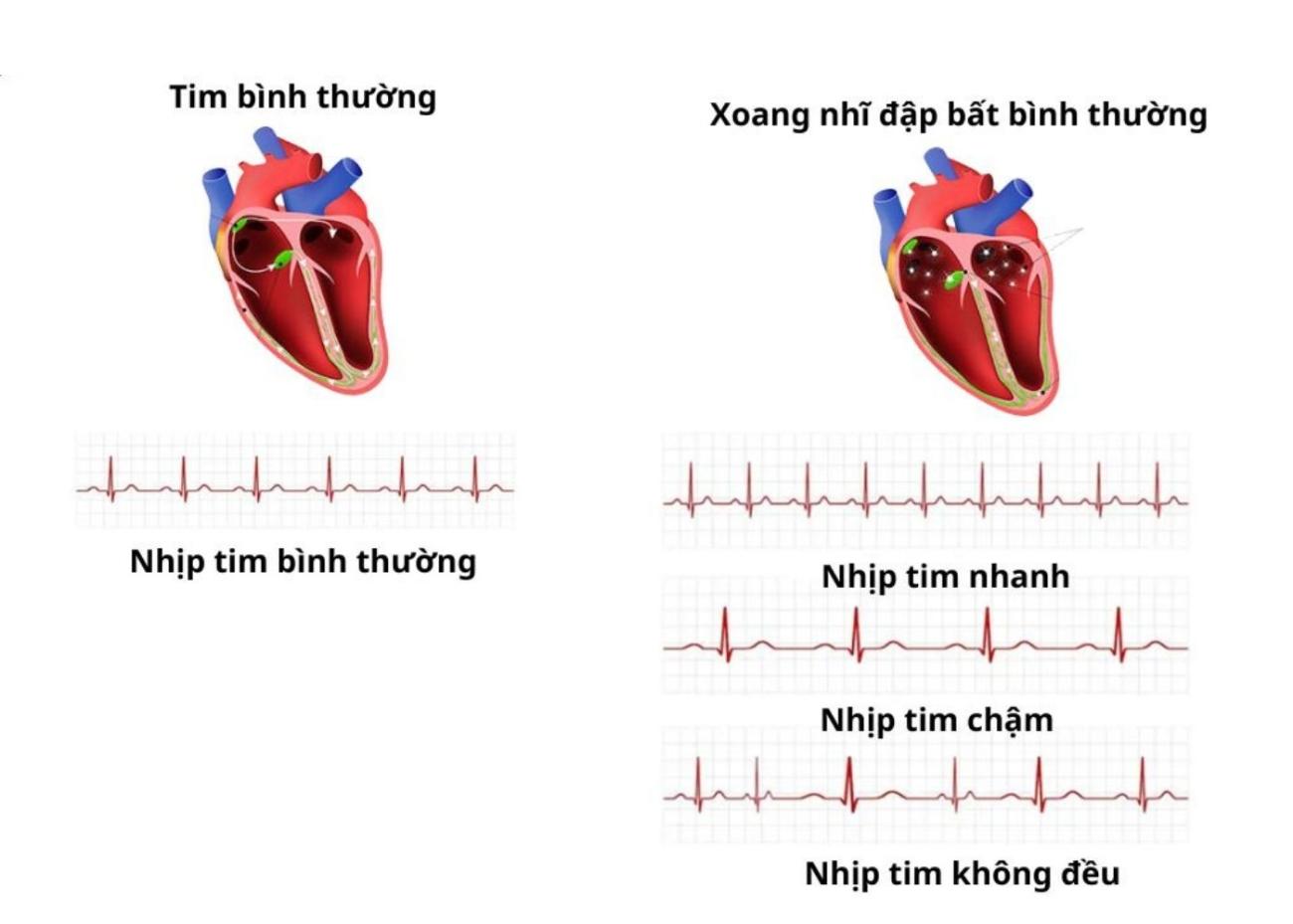Nhịp tim nhanh là gì?