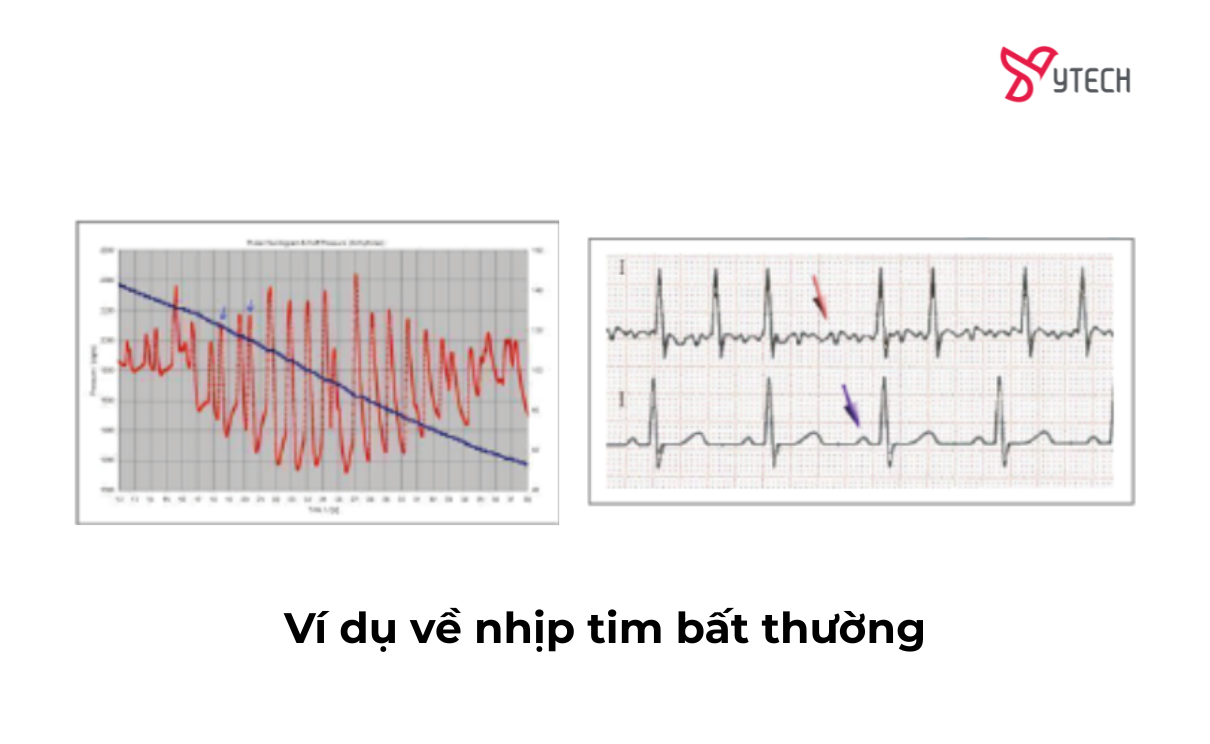 Nhận biết nhịp tim bất thường thông qua biểu đồ sóng mạch và điện tâm đồ. Hãy chủ động tầm soát sức khỏe tim mạch nếu bạn có dấu hiệu đánh trống ngực, khó thở.