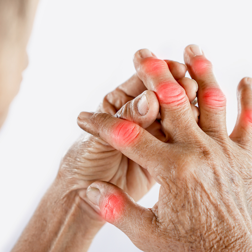 10 DẤU HIỆU BỆNH GOUT ĐIỂN HÌNH NHẤT NHẬN BIẾT SỚM QUA HÌNH ẢNH THỰC TẾ