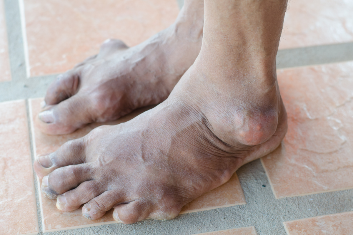 Bệnh gout có thể gây ra nhiều biến chứng nguy hiểm cho sức khỏe.