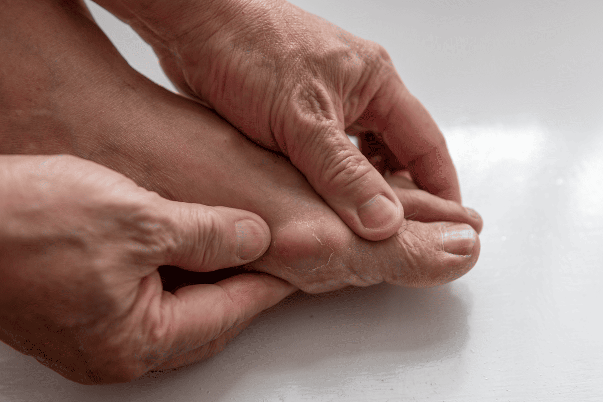 Các hạt tophi hình thành là giai đoạn bệnh gout mạn tính.