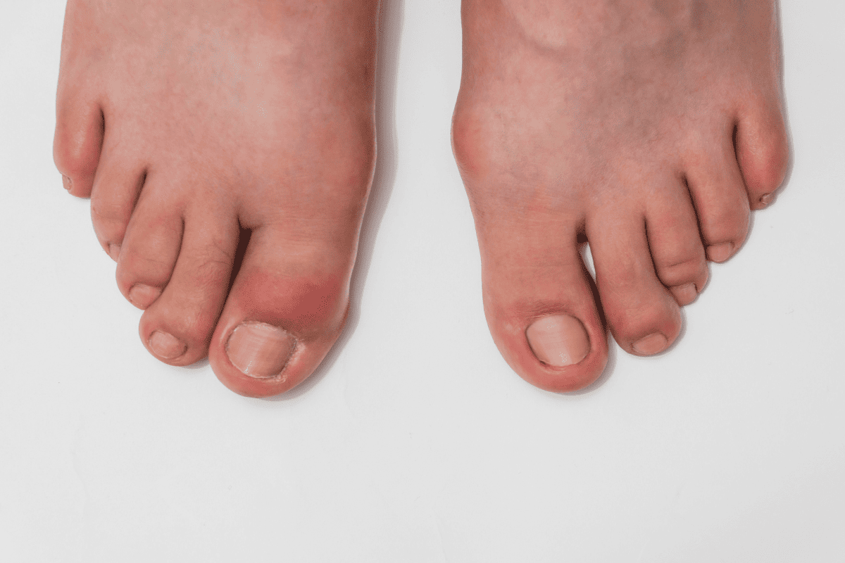 Cơn gout cấp tính gây sưng đỏ, nóng rát, đau dữ dội.